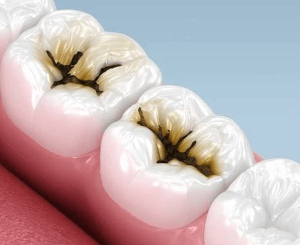 6 Ways To Lower Your Risk Of Future Cavities