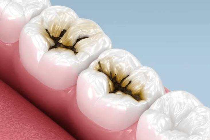6 Ways To Lower Your Risk Of Future Cavities